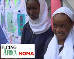 Intersurgical soutient Facing Africa NOMA